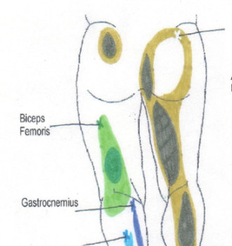 Zone douloureuse du Point Trigger du Biceps Femoris Zone douloureuse du Point Trigger du Biceps Femoris