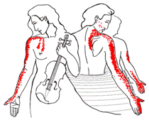 Zone douloureuse générée par un point Trigger du cou mimant une névralgie cervico-brachiale Zone douloureuse générée par un point Trigger du cou mimant une névralgie cervico-brachiale